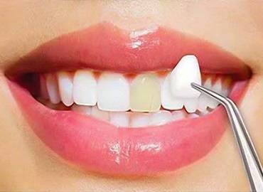 Dental Clinic in Gomti Nagar,Dental Clinic in vibhuti khand,Dental clinic in vishesh khand,dental clinic near shaheed path,Dentist in Gomti Nagar,Dentist in vibhuti khand,Dentist in vishesh khand,Dentist near shaheed path,Dental clinic in lucknow,dentist in lucknow,top dental clinic in gomti nagar,top dental clinic in vibhuti khand,top dental clinic in vishesh khand,top dental clinic  near shaheed path,top dentist in gomti nagar,top dentist in vibhuti khand,top dentist in vishesh khand