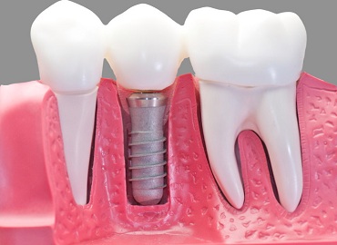 Dental Clinic in Engineering Colleges lucknow,Dental Clinic in vibhuti khand,Dental clinic in vishesh khand,dental clinic near shaheed path,Dentist in Gomti Nagar,Dentist in vibhuti khand,Dentist in vishesh khand,Dentist near shaheed path,Dental clinic in lucknow,dentist in lucknow,top dental clinic in gomti nagar,top dental clinic in vibhuti khand,top dental clinic in vishesh khand,top dental clinic  near shaheed path,top dentist in gomti nagar,top dentist in vibhuti khand,top dentist in vishesh khand